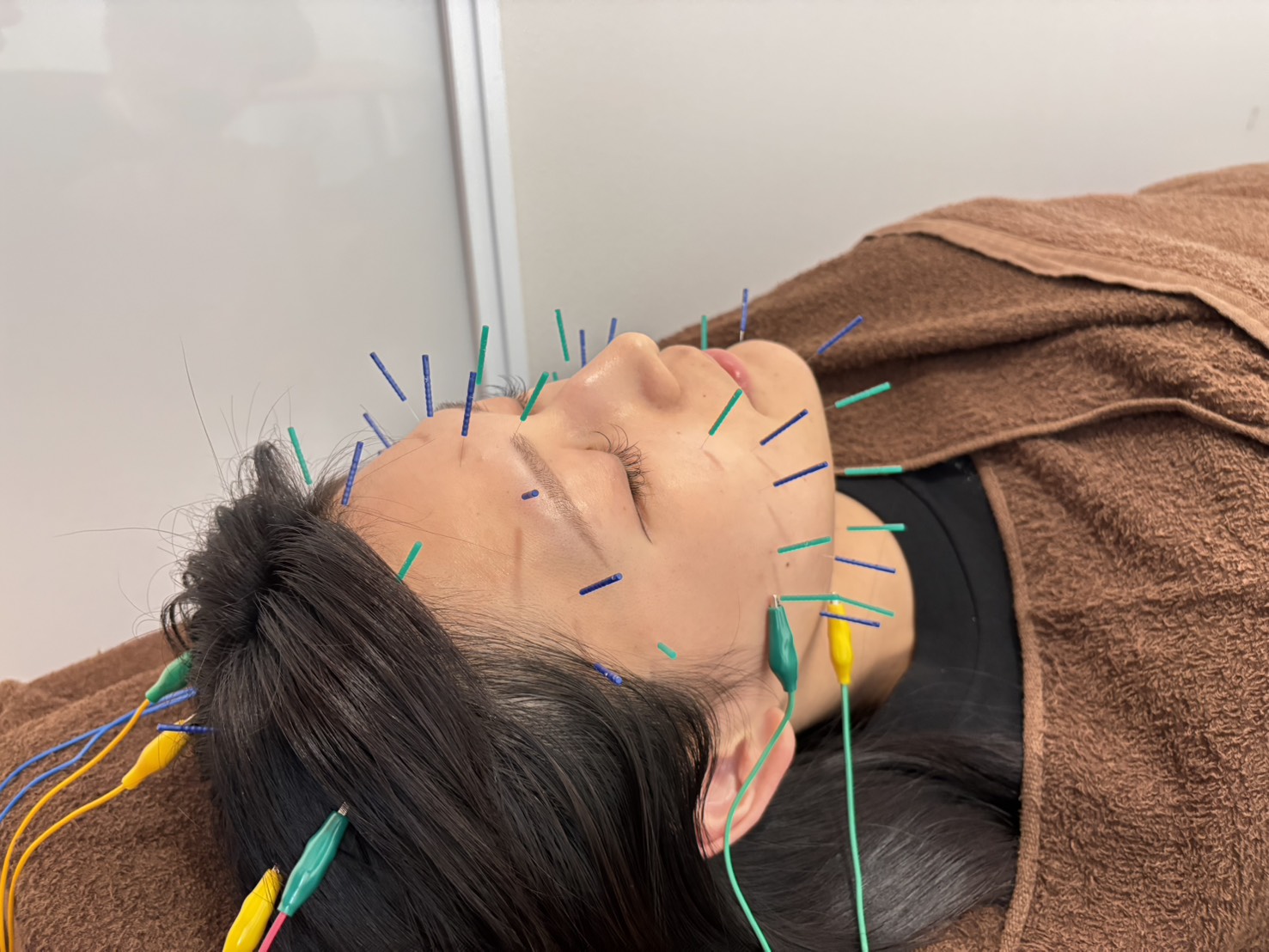 美容鍼の施術イメージ